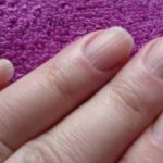 how-to-get-rid-of-longitudinal-stripes-on-the-nails-of-the-hands1