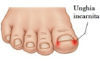 Unghia incarnita: i rimedi per combatterla