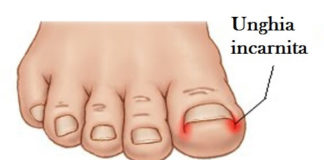 Unghia incarnita: i rimedi per combatterla