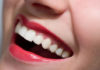 SOS denti bianchi: come avere un sorriso perfetto