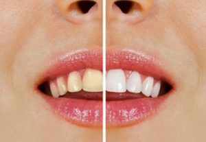 sbiancamento-denti