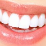 sbiancamento-denti-costo