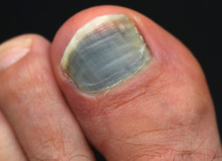 SOS unghia nera: le cause e i rimedi di questa patologia