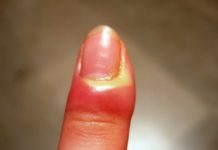 Sos giradito: le cause e le cure che dovete conoscere