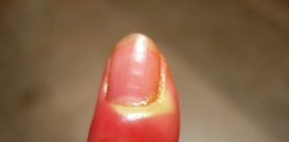 Sos giradito: le cause e le cure che dovete conoscere