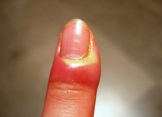 Sos giradito: le cause e le cure che dovete conoscere