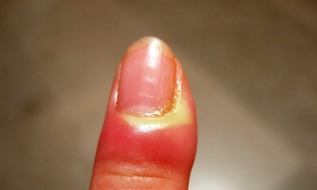 Sos giradito: le cause e le cure che dovete conoscere